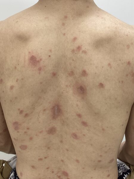 ステロイドが効かない、むず痒い、よく見るとフチが赤くかさかさを伴う紅斑…のアイキャッチ画像